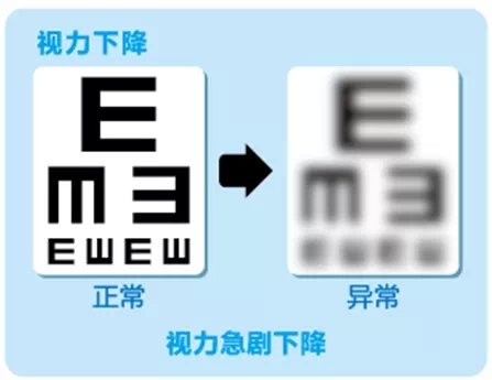 視網(wǎng)膜脫離啥癥狀？這張圖告訴你！