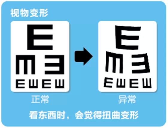 視網(wǎng)膜脫離啥癥狀？這張圖告訴你！