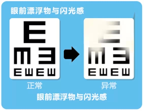 視網(wǎng)膜脫離啥癥狀？這張圖告訴你！