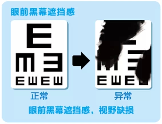 視網(wǎng)膜脫離啥癥狀？這張圖告訴你！