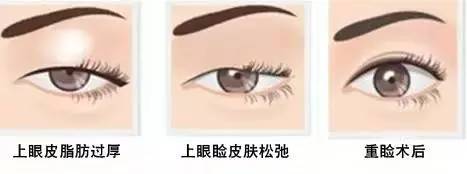 為什么要做雙眼皮？5個(gè)理由說服你！