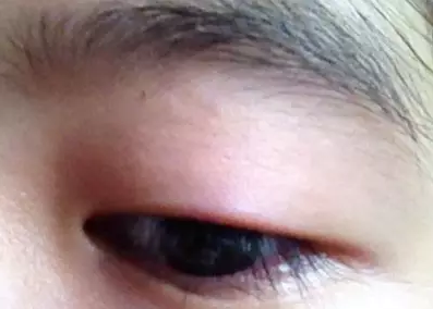 “美目貼”別依賴，小心眼皮下垂