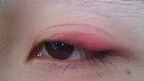 “美目貼”別依賴，小心眼皮下垂