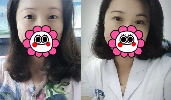 要不要做雙眼皮？別糾結了看這個！
