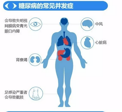 你造嗎？糖尿病晚期眼睛會(huì)致盲！