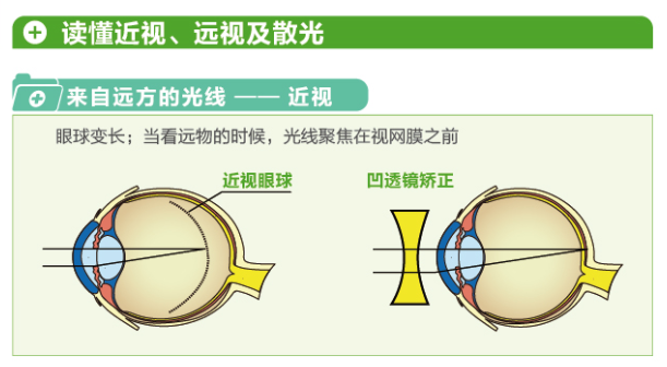 【看圖解】一張圖教你看懂近視、遠視和散光