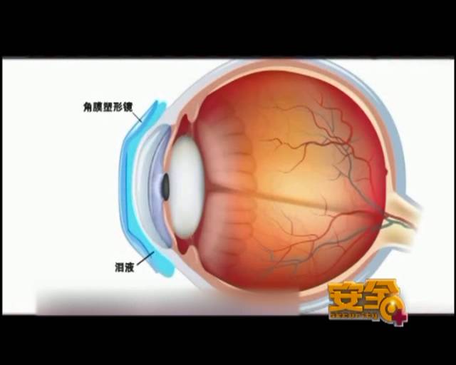 一夜之間真的能改變視力嗎？