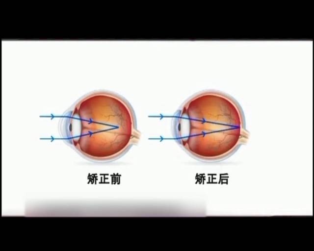 一夜之間真的能改變視力嗎？