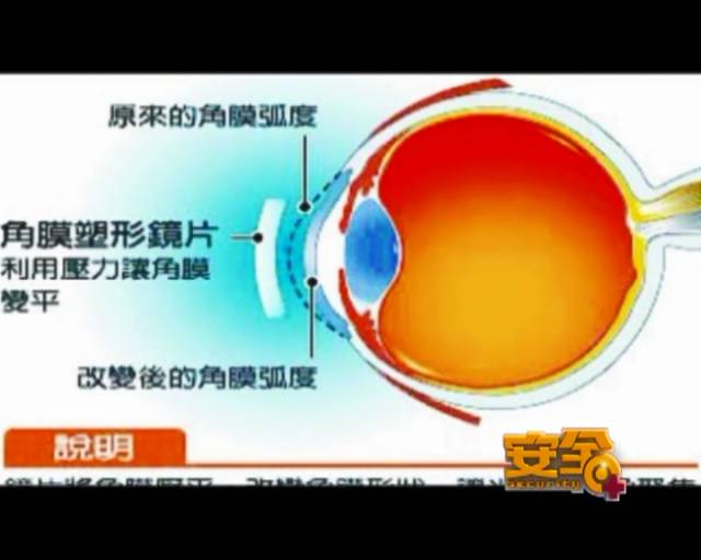 一夜之間真的能改變視力嗎？