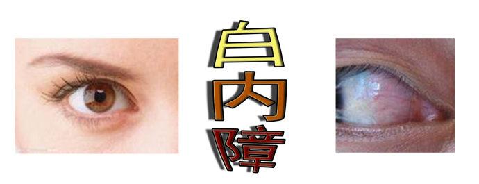 白內(nèi)障手術(shù)會(huì)反復(fù)嗎？