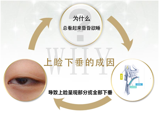 拯救惺忪睡眼，告別上瞼下垂！