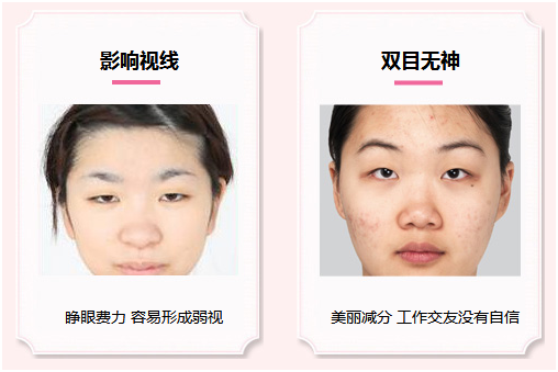 拯救惺忪睡眼，告別上瞼下垂！