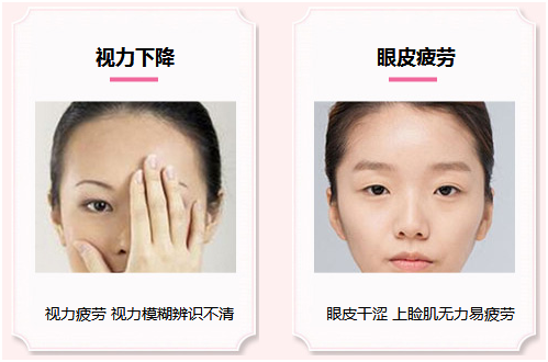 拯救惺忪睡眼，告別上瞼下垂！