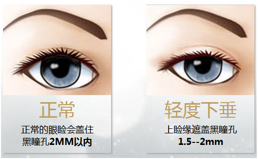 拯救惺忪睡眼，告別上瞼下垂！