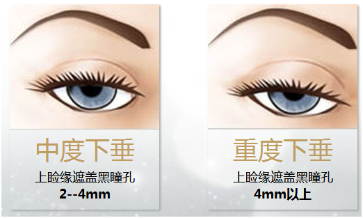 拯救惺忪睡眼，告別上瞼下垂！