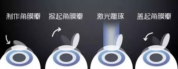 激光近視矯正和ICL晶體植入近視矯正攻略，