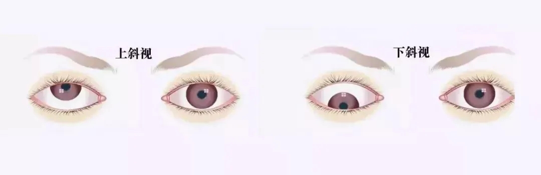 關(guān)于斜視，這幾個誤區(qū)害人不淺!