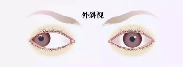 關(guān)于斜視，這幾個誤區(qū)害人不淺!