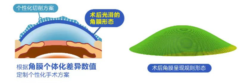微雕優(yōu)視飛秒，重新定義角膜屈光手術(shù)，讓視力多看一行！
